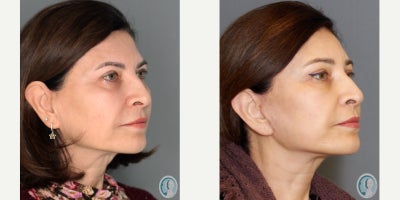 Facial Fat Transfer before and after photo