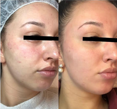 Microneedling before and after photo