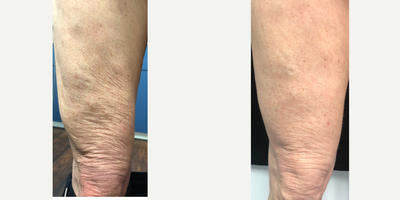 Microneedling before and after photo