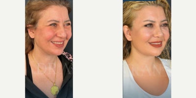 Rhinoplasty before and after photo