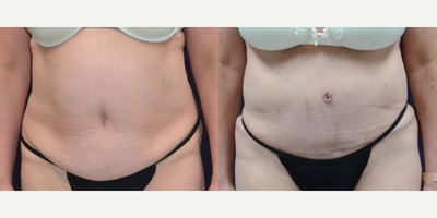 Tummy Tuck before and after photo