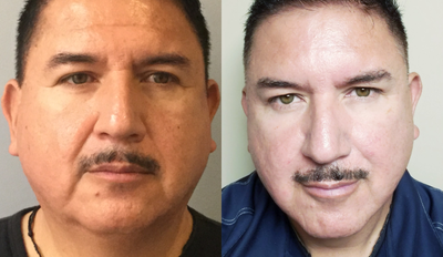 Bellafill before and after photo