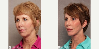 Brow Lift before and after photo