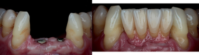 Dental Crown before and after photo