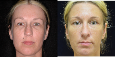 Rhinoplasty before and after photo
