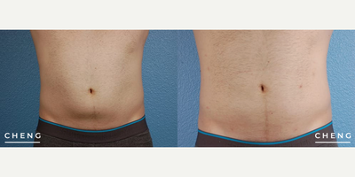 Smart Lipo before and after photo