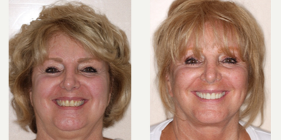 Smile Makeover before and after photo