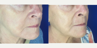Dermal Fillers before and after photo