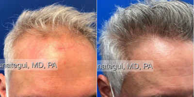 FUE Hair Transplant before and after photo