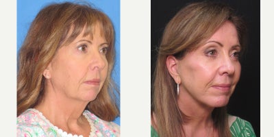 Brow Lift before and after photo