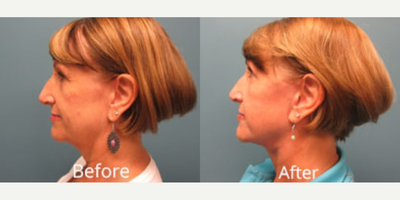 Facelift before and after photo