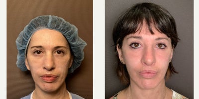 Facelift before and after photo