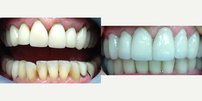 Dental Crown before and after photo