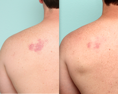 IPL before and after photo