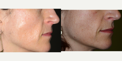 Sculptra before and after photo