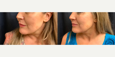 Voluma before and after photo