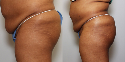 Brazilian Butt Lift before and after photo