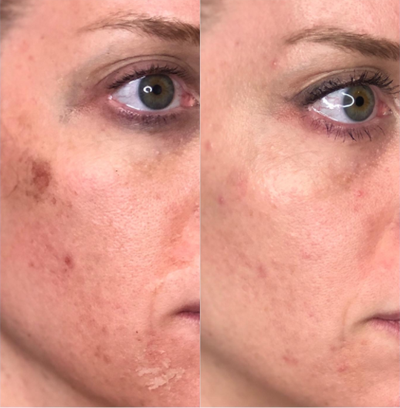 Chemical Peel before and after photo