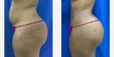 Liposuction before and after photo