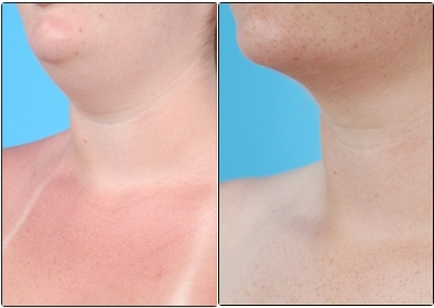 Smart Lipo before and after photo