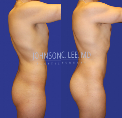 Brazilian Butt Lift before and after photo