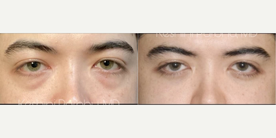 Eyelid Surgery before and after photo