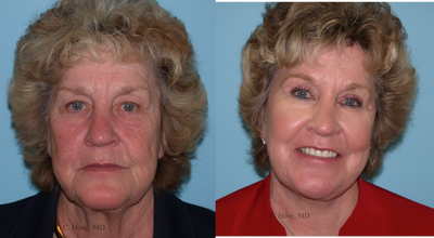 Facelift before and after photo