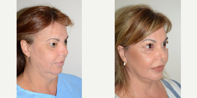 Facelift before and after photo