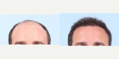 Hair Transplant before and after photo