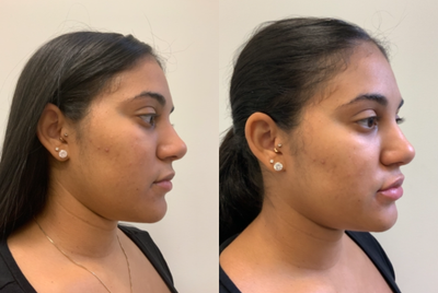 Juvederm before and after photo