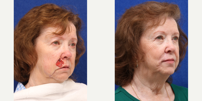 Facial Reconstructive Surgery before and after photo