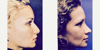Rhinoplasty before and after photo