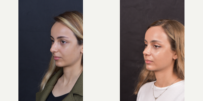 Rhinoplasty before and after photo