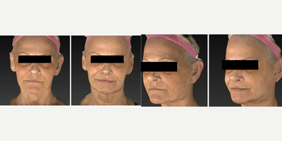 Dermal Fillers before and after photo