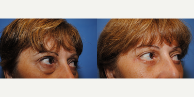 Eyelid Surgery before and after photo