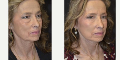Eyelid Surgery before and after photo