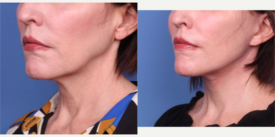 Facelift before and after photo