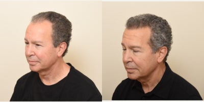 Hair Transplant before and after photo