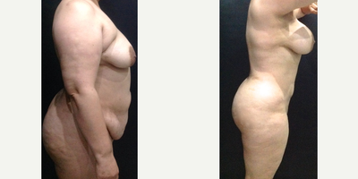 Mommy Makeover before and after photo