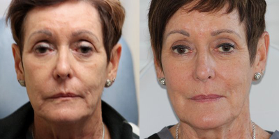 Sculptra before and after photo