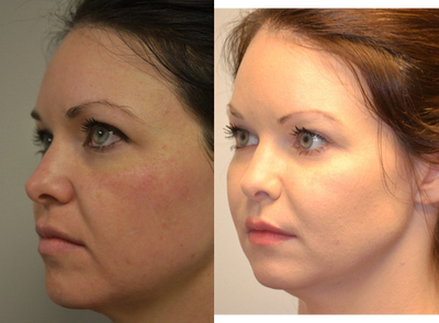 Voluma before and after photo