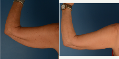 Arm Lift before and after photo