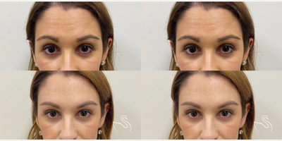 Botox before and after photo