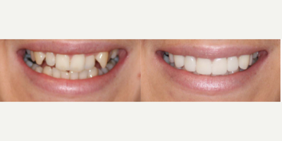 Dental Crown before and after photo
