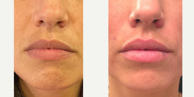Dermal Fillers before and after photo
