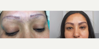 FUE Hair Transplant before and after photo