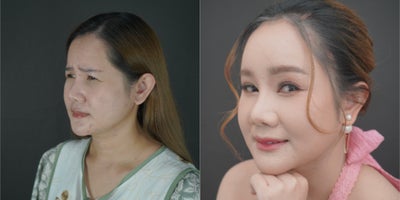 Eyelid Surgery before and after photo