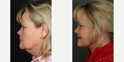 Facelift before and after photo