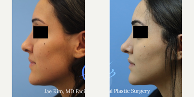 Rhinoplasty before and after photo