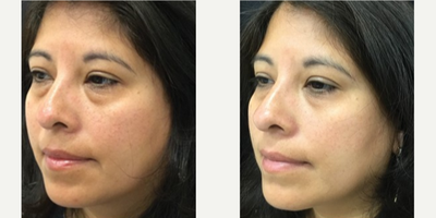 TempSure Envi before and after photo